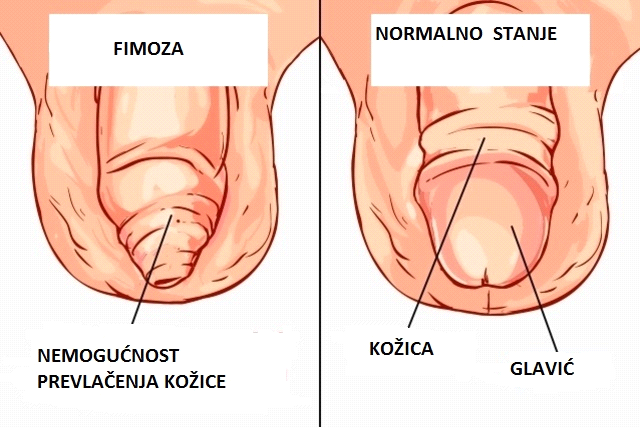 image1 Fimoze, parafimoze - Dr Zejnilović, Dnevna bolnica i Laboratorija